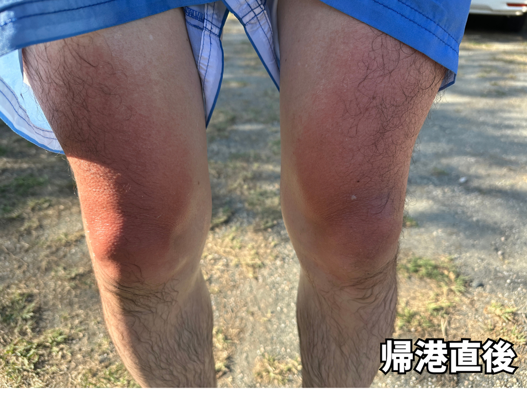 帰港直後の日焼けの様子