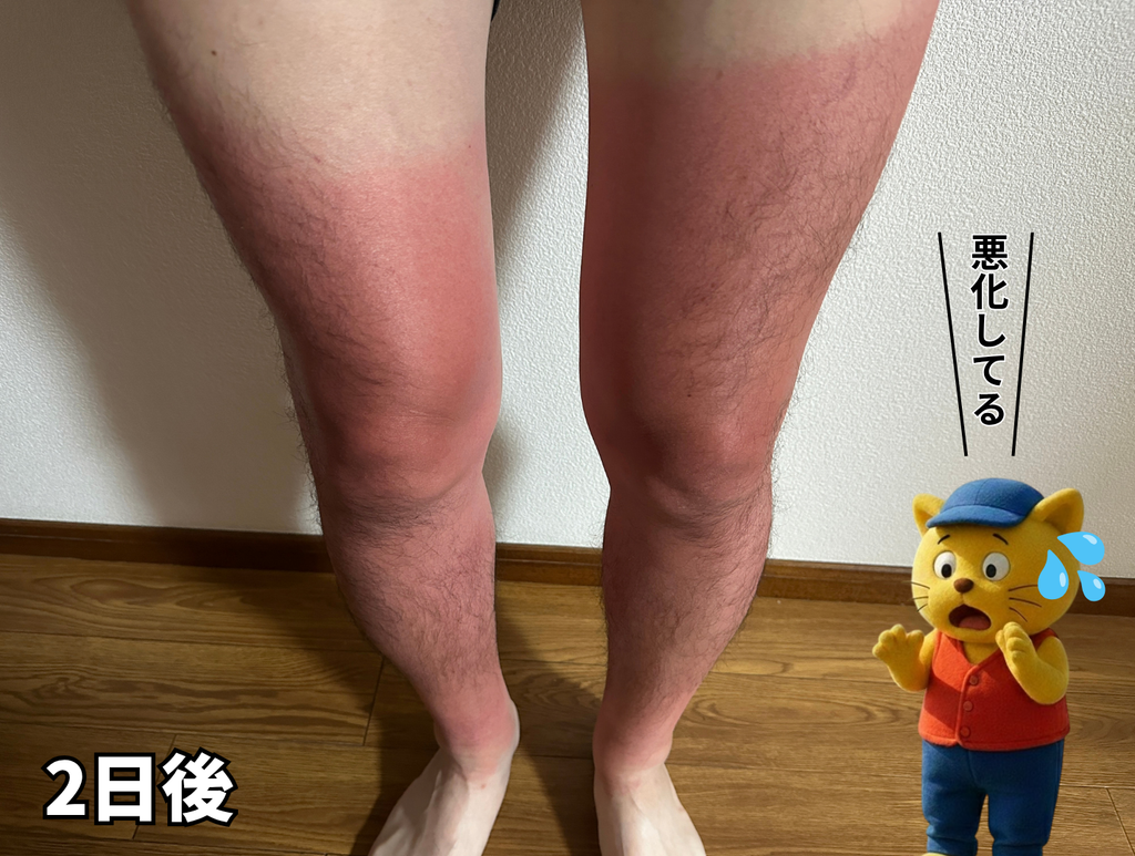 カヤックフィッシング2日後の日焼けの様子。火傷みたいになっている